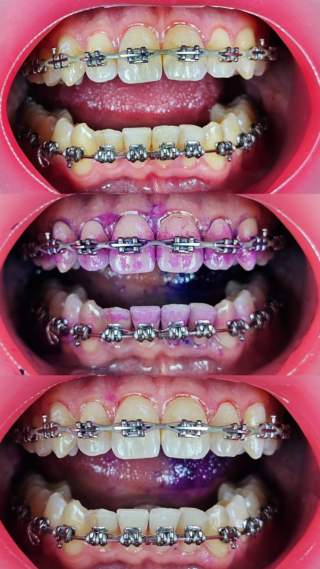 Cheek & Lip Retraction in Dentistry: Techniques, Tools & Best Practices