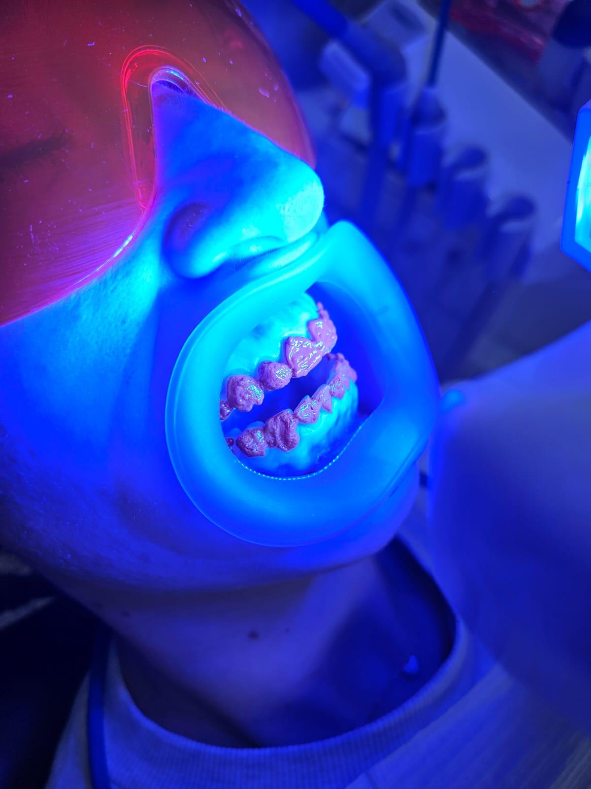 Best Lip & Cheek Retractor for Teeth Whitening (Buyer's Guide)